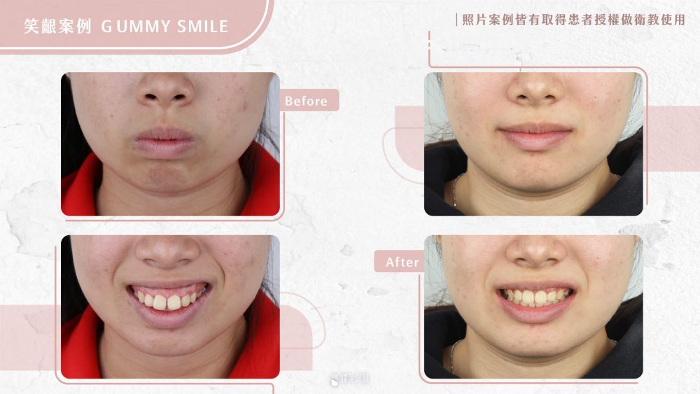 齒顎矯正專科醫師-陳威仲醫師笑齦案例比較