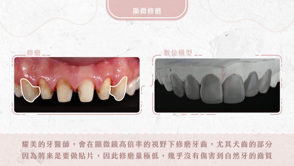 前牙美學全瓷貼片案例分享