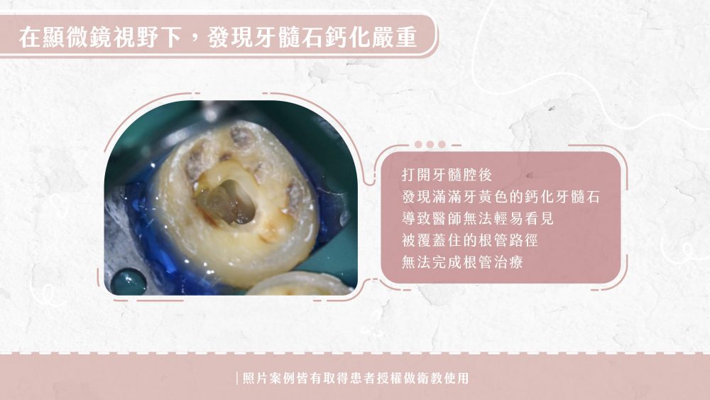 20221012-耀美網站-廖醫師牙髓治療案例(鈣化根管)-01