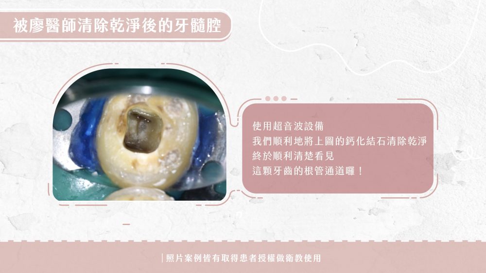 20221012-耀美網站-廖醫師牙髓治療案例(鈣化根管)-01
