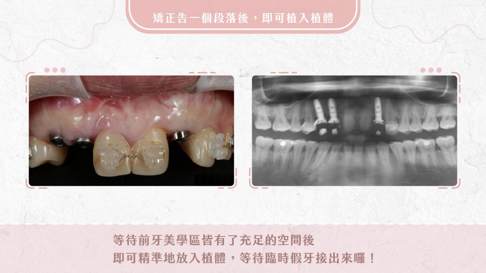 耀美牙醫人工植牙案例分享