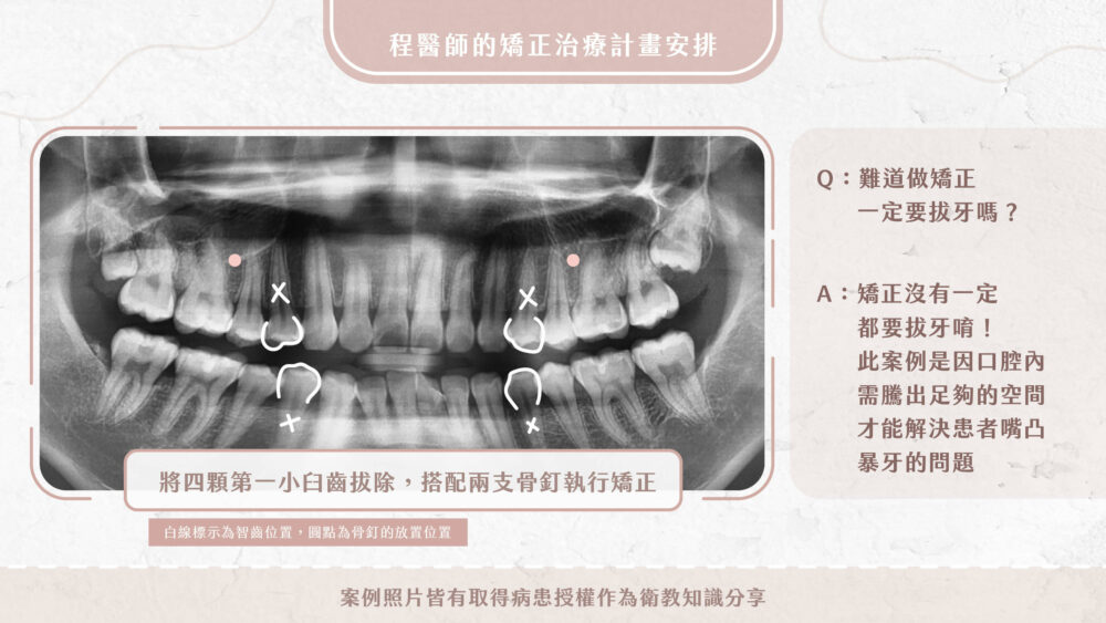 暴牙、嘴凸矯正案例-耀美牙醫矯正專科-程文鐸醫師
