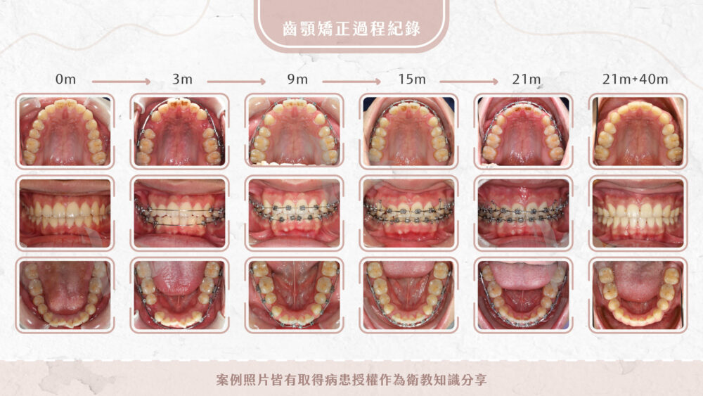 暴牙、嘴凸矯正案例-耀美牙醫矯正專科-程文鐸醫師
